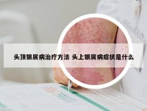 头顶银屑病治疗方法 头上银屑病症状是什么