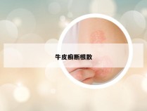 牛皮癣断根散