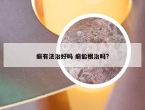 癣有法治好吗 癣能根治吗?