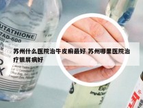 苏州什么医院治牛皮癣最好 苏州哪里医院治疗银屑病好