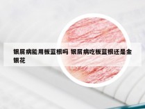 银屑病能用板蓝根吗 银屑病吃板蓝根还是金银花