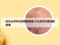 吃什么药可以控制银屑病 什么药可以根治银屑病