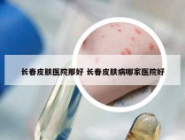 长春皮肤医院那好 长春皮肤病哪家医院好