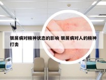 银屑病对精神状态的影响 银屑病对人的精神打击