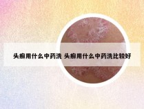 头癣用什么中药洗 头癣用什么中药洗比较好