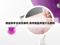 膝盖换季会有皮癣吗 换季膝盖疼是什么原因