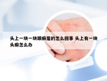 头上一块一块跟癣是的怎么回事 头上有一块头癣怎么办