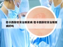 他卡西醇软膏治银屑病 他卡西醇软膏治银屑病好吗