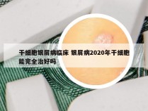 干细胞银屑病临床 银屑病2020年干细胞能完全治好吗