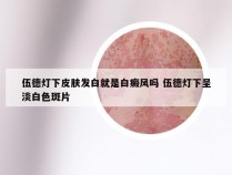 伍德灯下皮肤发白就是白癜风吗 伍德灯下呈淡白色斑片