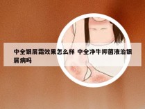 中全银屑霜效果怎么样 中全净牛抑菌液治银屑病吗