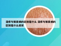 湿疹与银屑病的区别是什么 湿疹与银屑病的区别是什么症状