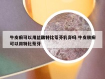 牛皮癣可以用盐酸特比萘芬乳膏吗 牛皮肤癣可以用特比萘芬