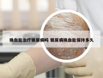 换血能治疗银屑病吗 银屑病换血能保持多久