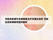 河南皮肤病牛皮癣哪里治疗效果比较好 河南治皮肤病哪家医院最好