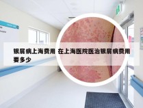 银屑病上海费用 在上海医院医治银屑病费用要多少