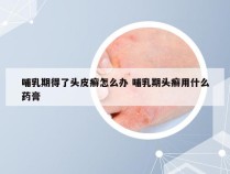 哺乳期得了头皮癣怎么办 哺乳期头癣用什么药膏