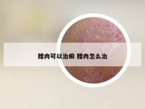 腊肉可以治癣 腊肉怎么治