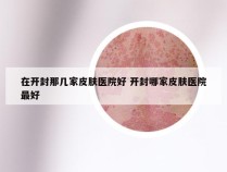 在开封那几家皮肤医院好 开封哪家皮肤医院最好