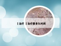 廯治疗 廯治疗要多久时间