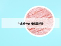 牛皮癣什么时候最好治