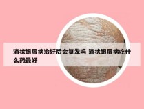 滴状银屑病治好后会复发吗 滴状银屑病吃什么药最好