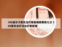 308准分子激光治疗银屑病需要做几次 308激光治疗仪治疗银屑病