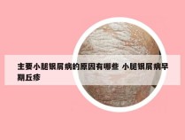 主要小腿银屑病的原因有哪些 小腿银屑病早期丘疹