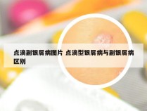 点滴副银屑病图片 点滴型银屑病与副银屑病区别