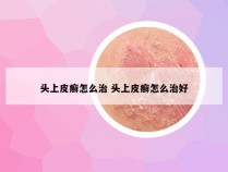 头上皮癣怎么治 头上皮癣怎么治好