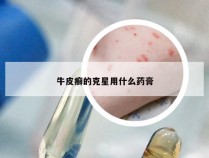 牛皮癣的克星用什么药膏