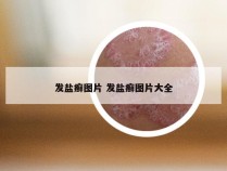 发盐癣图片 发盐癣图片大全