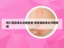 同仁堂血毒丸治银屑病 银屑病血毒丸对银屑病