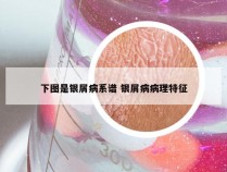 下图是银屑病系谱 银屑病病理特征