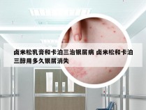 卤米松乳膏和卡泊三治银屑病 卤米松和卡泊三醇用多久银屑消失