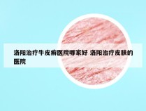 洛阳治疗牛皮癣医院哪家好 洛阳治疗皮肤的医院