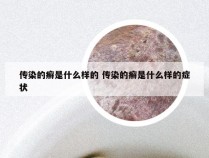 传染的癣是什么样的 传染的癣是什么样的症状