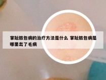 掌趾脓包病的治疗方法是什么 掌趾脓包病是哪里出了毛病