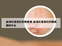 由浅红变深红的银屑病 由浅红变深红的银屑病叫什么