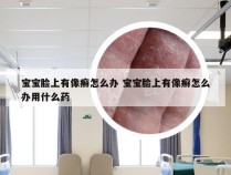 宝宝脸上有像癣怎么办 宝宝脸上有像癣怎么办用什么药