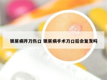 银屑病开刀伤口 银屑病手术刀口后会复发吗