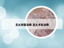 怎么样医治癣 怎么才能治癣