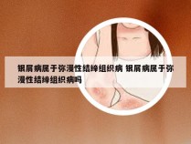 银屑病属于弥漫性结缔组织病 银屑病属于弥漫性结缔组织病吗