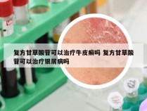 复方甘草酸苷可以治疗牛皮癣吗 复方甘草酸苷可以治疗银屑病吗