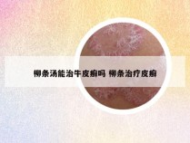 柳条汤能治牛皮癣吗 柳条治疗皮癣