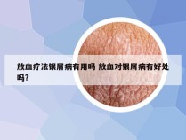 放血疗法银屑病有用吗 放血对银屑病有好处吗?