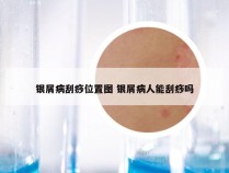 银屑病刮痧位置图 银屑病人能刮痧吗