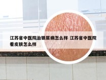 江苏省中医院治银屑病怎么样 江苏省中医院看皮肤怎么样