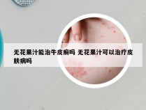 无花果汁能治牛皮癣吗 无花果汁可以治疗皮肤病吗