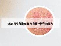 怎么用皂角治皮癣 皂角治疗脚气的配方